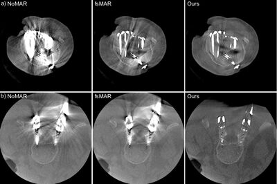 View-Consistent Metal Segmentation in the Projection Domain for Metal Artifact Reduction in CBCT – An Investigation of Potential Improvement cover file