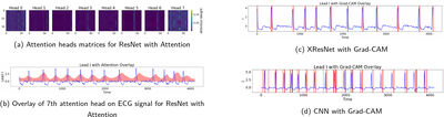 Investigating sex bias in ECG classification for Atrial Fibrillation, Sinus Rhythm and Myocardial Infarction cover file