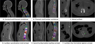 CTSpine1K: A Large-Scale Dataset for Spinal Vertebrae Segmentation  in Computed Tomography cover file