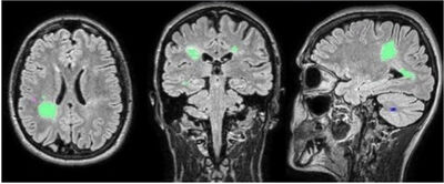 SibBMS: Siberian Brain Multiple Sclerosis Dataset with lesion segmentation and patient meta information cover file