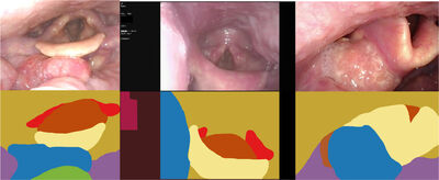 SCOPE-HN: A Segmentation-based Collection of OroPharyngeal Structures Using Flexible Endoscopy for Head and Neck Cancers cover file