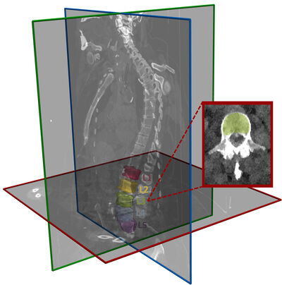 Spinal-Multiple-Myeloma-SEG: A Dual-Energy CT Dataset Extended with Trabecular Bone Segmentation of Lumbar Vertebrae cover file